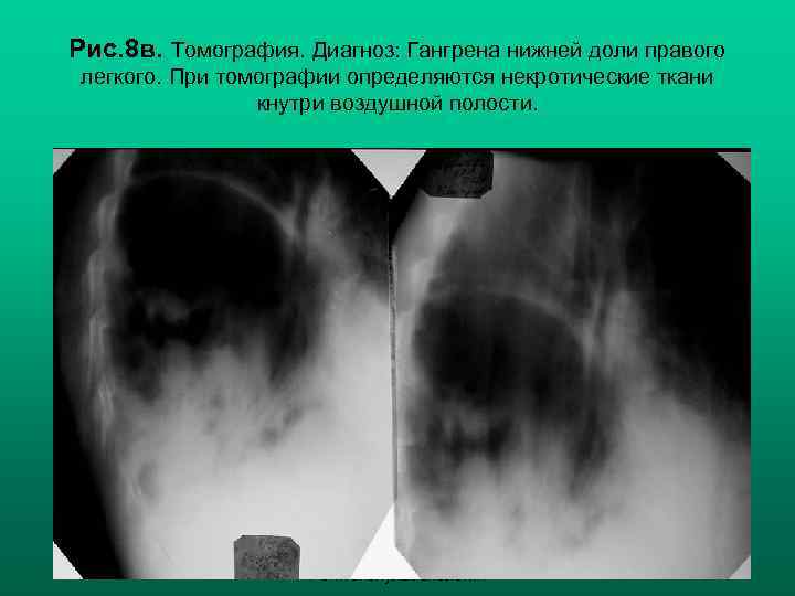 Рис. 8 в. Томография. Диагноз: Гангрена нижней доли правого легкого. При томографии определяются некротические