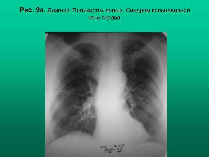 Рис. 9 а. Диагноз: Поликистоз легких. Синдром кольцевидной тени справа. Н. С. Воротынцева, С.