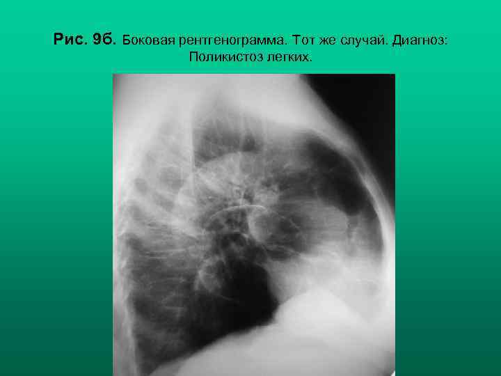 Рис. 9 б. Боковая рентгенограмма. Тот же случай. Диагноз: Поликистоз легких. Н. С. Воротынцева,