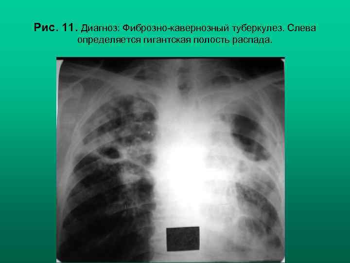 Рис. 11. Диагноз: Фиброзно-кавернозный туберкулез. Слева определяется гигантская полость распада. Н. С. Воротынцева, С.