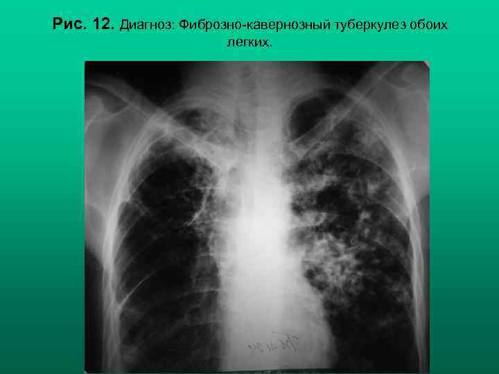 Рис. 12. Диагноз: Фиброзно-кавернозный туберкулез обоих легких. Н. С. Воротынцева, С. С. Гольев Рентгенопульмонология