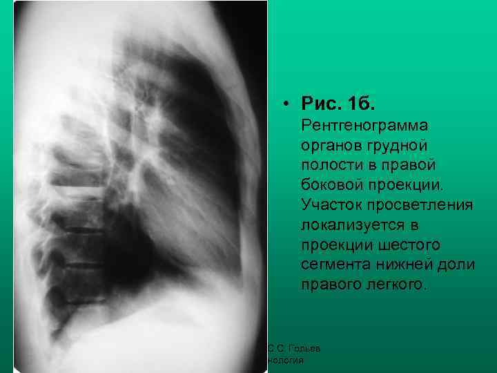  • Рис. 1 б. Рентгенограмма органов грудной полости в правой боковой проекции. Участок