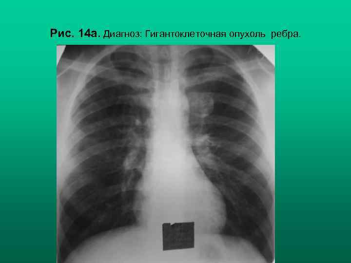 Рис. 14 а. Диагноз: Гигантоклеточная опухоль ребра. Н. С. Воротынцева, С. С. Гольев Рентгенопульмонология