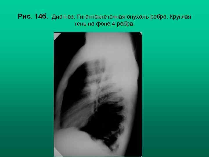 Рис. 14 б. Диагноз: Гигантоклеточная опухоль ребра. Круглая тень на фоне 4 ребра. Н.