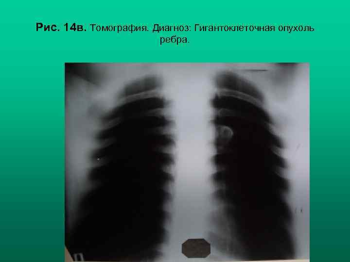 Рис. 14 в. Томография. Диагноз: Гигантоклеточная опухоль ребра. Н. С. Воротынцева, С. С. Гольев