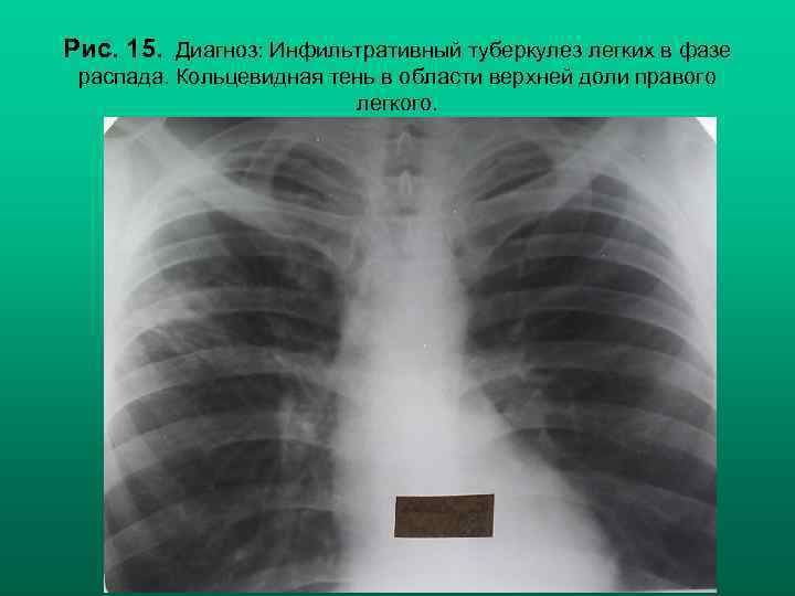 Рис. 15. Диагноз: Инфильтративный туберкулез легких в фазе распада. Кольцевидная тень в области верхней