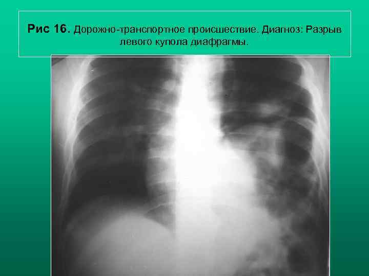 Рис 16. Дорожно-транспортное происшествие. Диагноз: Разрыв левого купола диафрагмы. Н. С. Воротынцева, С. С.