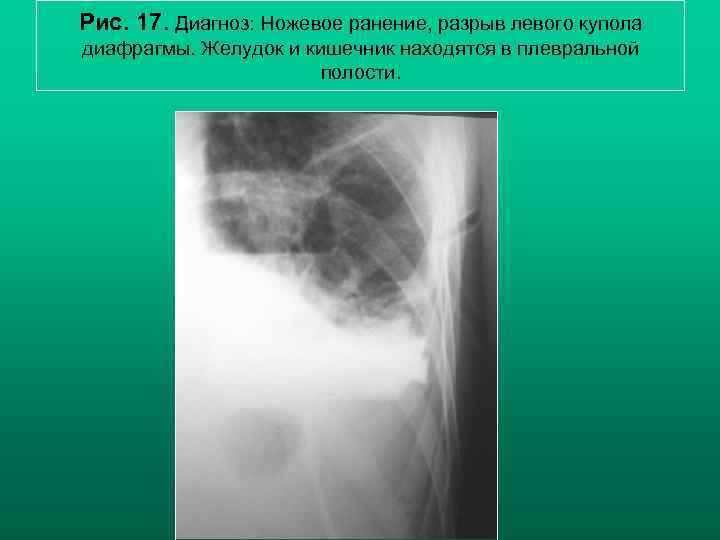 Рис. 17. Диагноз: Ножевое ранение, разрыв левого купола диафрагмы. Желудок и кишечник находятся в