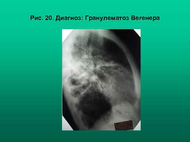 Рис. 20. Диагноз: Гранулематоз Вегенера 