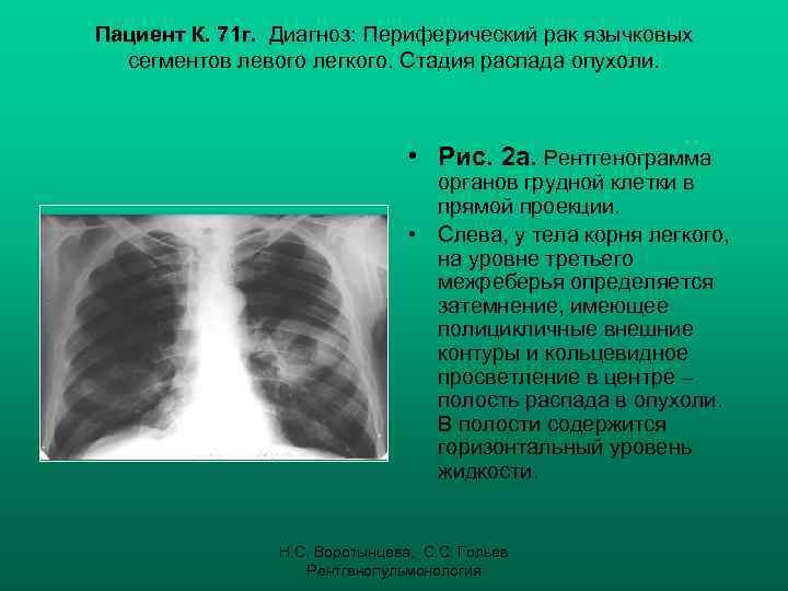 Пациент К. 71 г. Диагноз: Периферический рак язычковых сегментов левого легкого. Стадия распада опухоли.