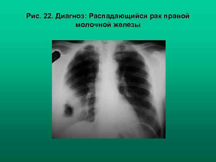 Рис. 22. Диагноз: Распадающийся рак правой молочной железы 