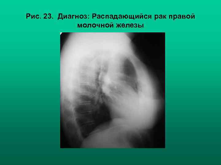 Рис. 23. Диагноз: Распадающийся рак правой молочной железы 