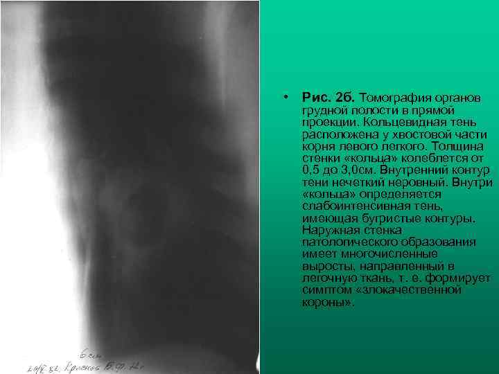  • Рис. 2 б. Томография органов грудной полости в прямой проекции. Кольцевидная тень