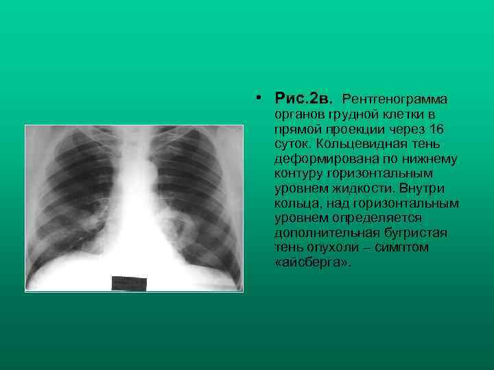  • Рис. 2 в. Рентгенограмма органов грудной клетки в прямой проекции через 16