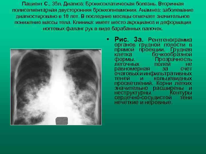 Пациент С. , 35 л. Диагноз: Бронхоэктатическая болезнь. Вторичная полисегментарная двусторонняя бронхопневмония. Анамнез: заболевание