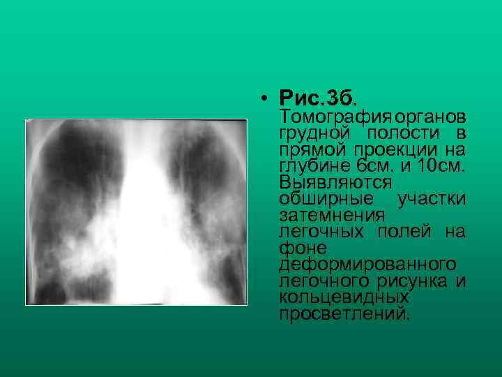  • Рис. 3 б. Томография органов грудной полости в прямой проекции на глубине