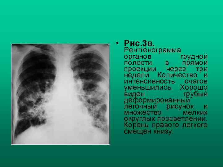  • Рис. 3 в. Рентгенограмма органов грудной полости в прямой проекции через три