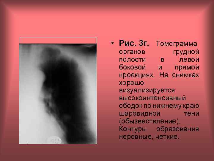  • Рис. 3 г. Томограмма органов грудной полости в левой боковой и прямой