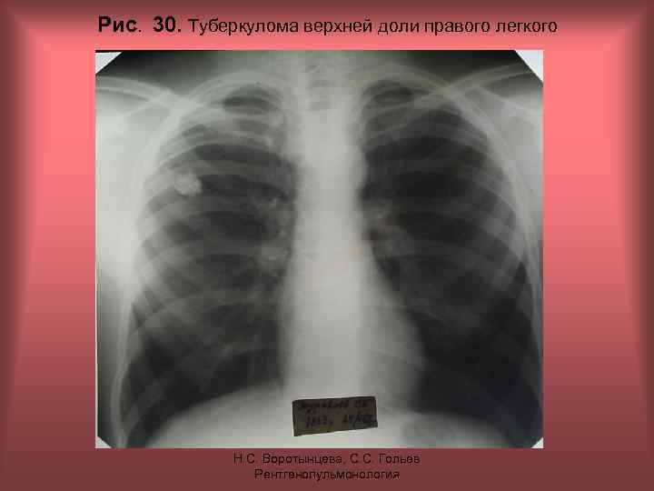 Рис. 30. Туберкулома верхней доли правого легкого Н. С. Воротынцева, С. С. Гольев Рентгенопульмонология
