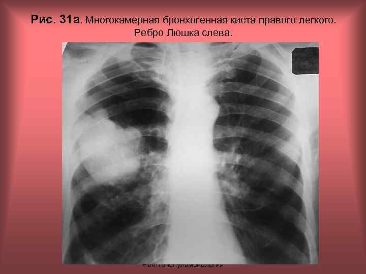 Рис. 31 а. Многокамерная бронхогенная киста правого легкого. Ребро Люшка слева. Н. С. Воротынцева,