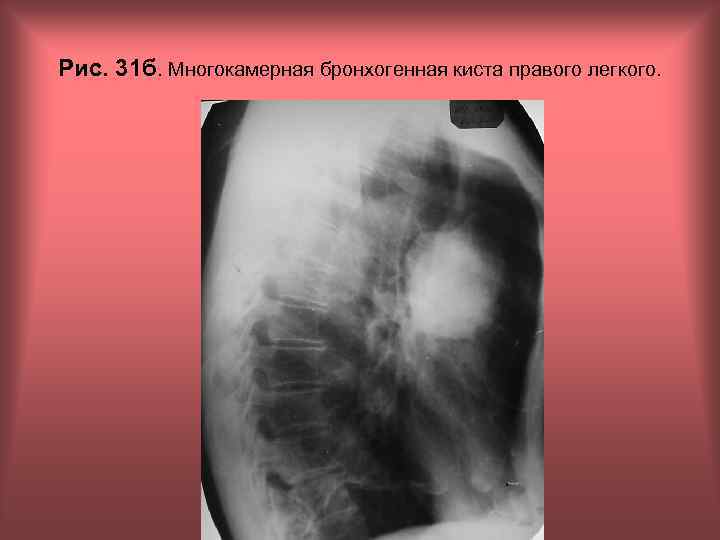 Рис. 31 б. Многокамерная бронхогенная киста правого легкого. Н. С. Воротынцева, С. С. Гольев