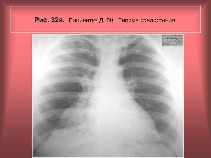 Рис. 32 а. Пациентка Д. 50. Липома средостения. Н. С. Воротынцева, С. С. Гольев