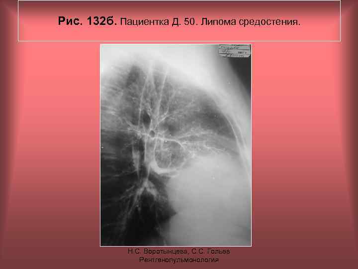 Рис. 132 б. Пациентка Д. 50. Липома средостения. Н. С. Воротынцева, С. С. Гольев