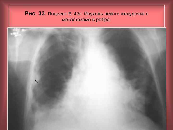 Рис. 33. Пациент Б. 43 г. Опухоль левого желудочка с метастазами в ребра. Н.