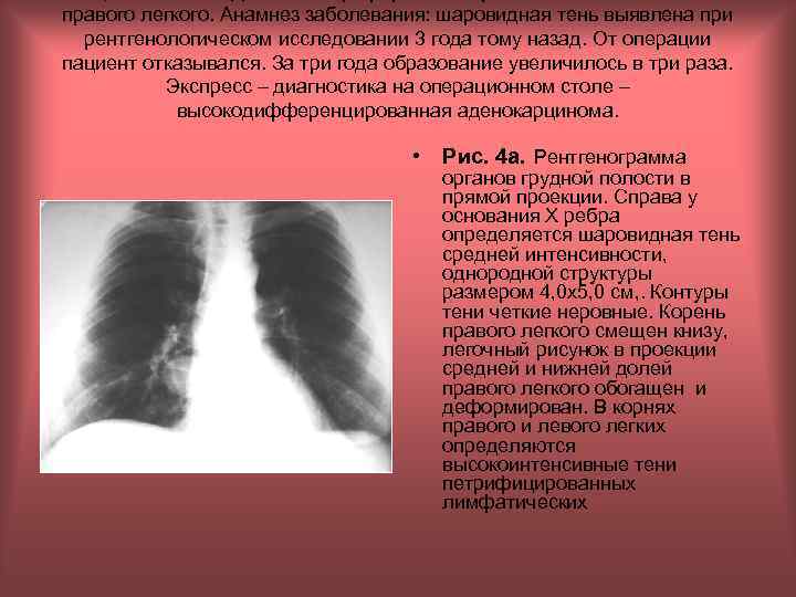 правого легкого. Анамнез заболевания: шаровидная тень выявлена при рентгенологическом исследовании 3 года тому назад.