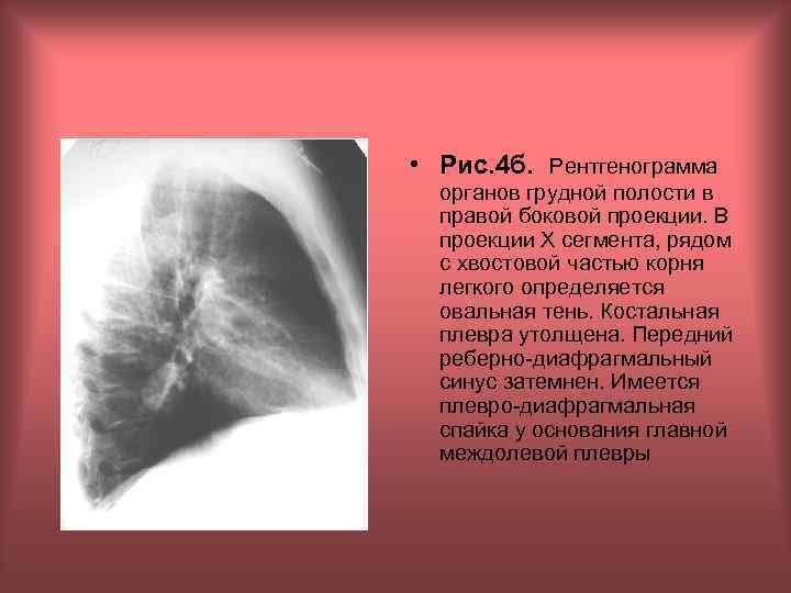  • Рис. 4 б. Рентгенограмма органов грудной полости в правой боковой проекции. В