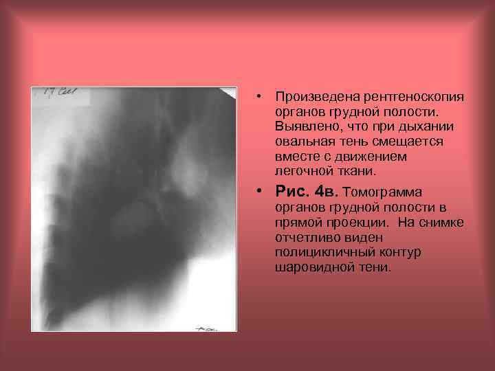  • Произведена рентгеноскопия органов грудной полости. Выявлено, что при дыхании овальная тень смещается