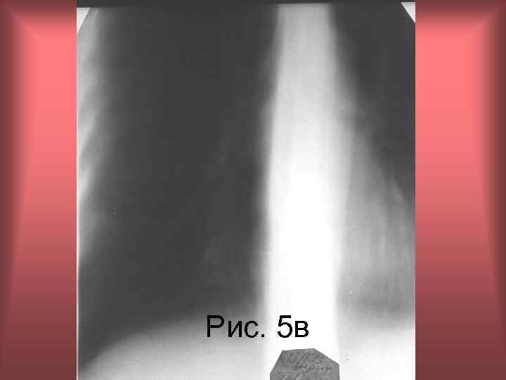 Рис. 5 в Н. С. Воротынцева, С. С. Гольев Рентгенопульмонология 