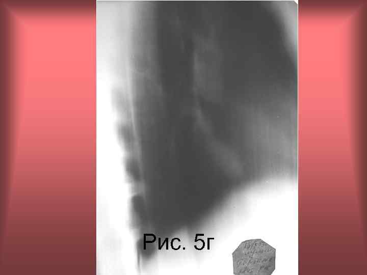 Рис. 5 г Н. С. Воротынцева, С. С. Гольев Рентгенопульмонология 