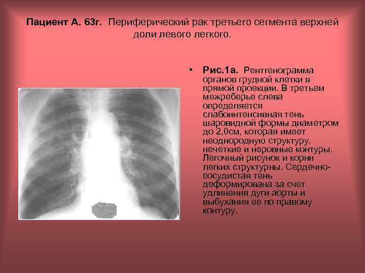 Пациент А. 63 г. Периферический рак третьего сегмента верхней доли левого легкого. • Рис.
