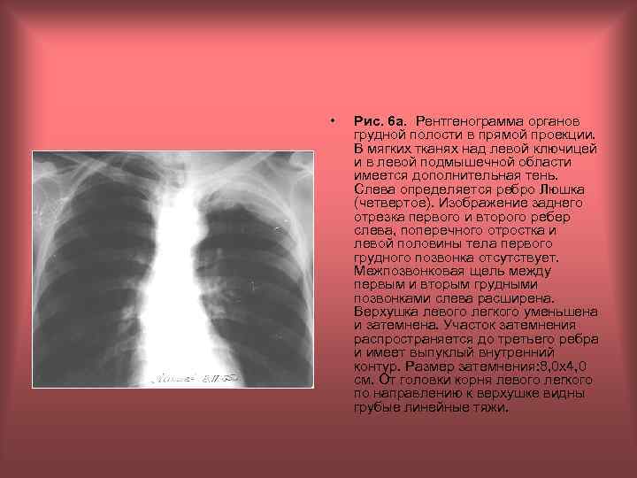  • Рис. 6 а. Рентгенограмма органов грудной полости в прямой проекции. В мягких