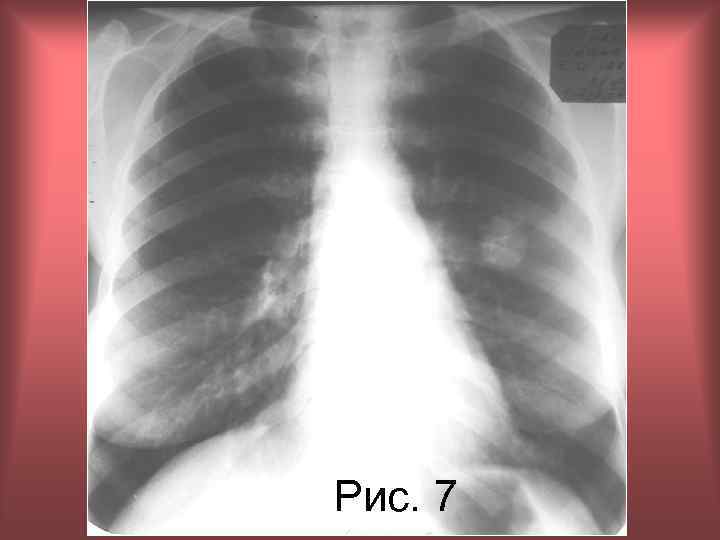 Рис. 7 Н. С. Воротынцева, С. С. Гольев Рентгенопульмонология 