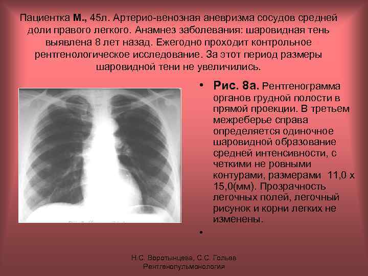 Пациентка М. , 45 л. Артерио-венозная аневризма сосудов средней доли правого легкого. Анамнез заболевания: