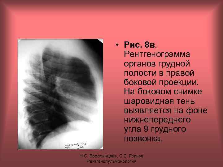  • Рис. 8 в. Рентгенограмма органов грудной полости в правой боковой проекции. На