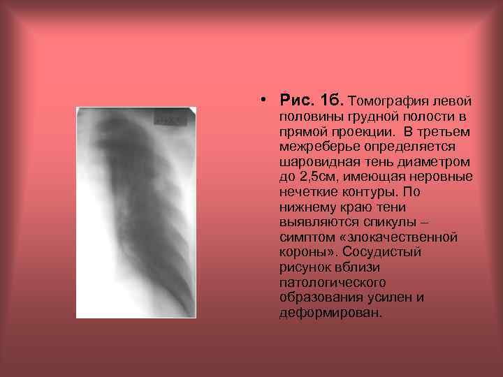  • Рис. 1 б. Томография левой половины грудной полости в прямой проекции. В