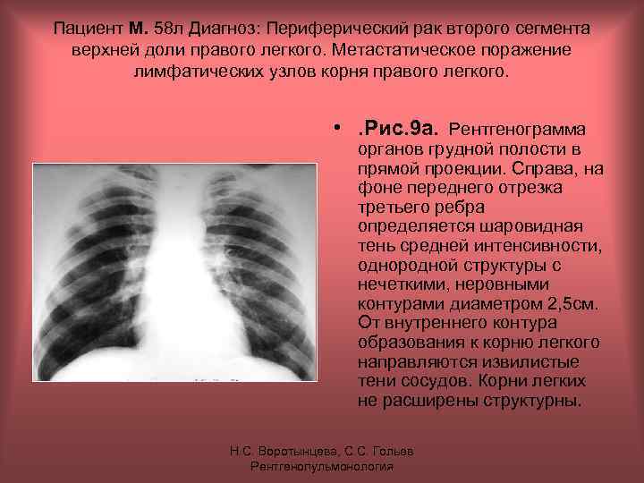 Пациент М. 58 л Диагноз: Периферический рак второго сегмента верхней доли правого легкого. Метастатическое