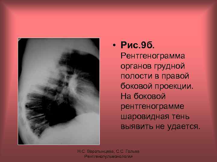  • Рис. 9 б. Рентгенограмма органов грудной полости в правой боковой проекции. На