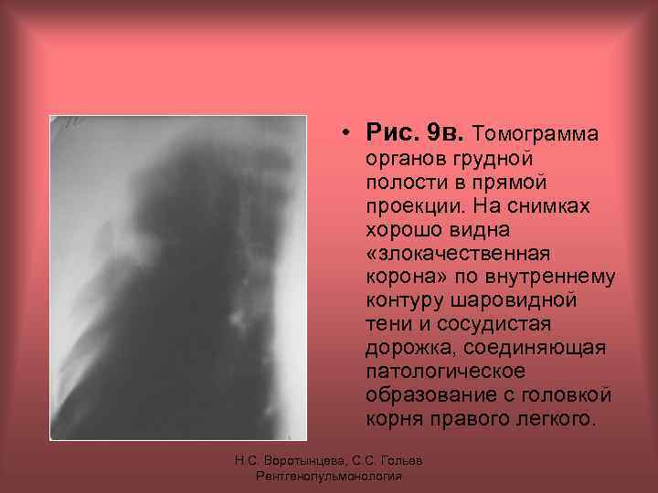  • Рис. 9 в. Томограмма органов грудной полости в прямой проекции. На снимках