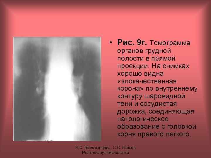  • Рис. 9 г. Томограмма органов грудной полости в прямой проекции. На снимках