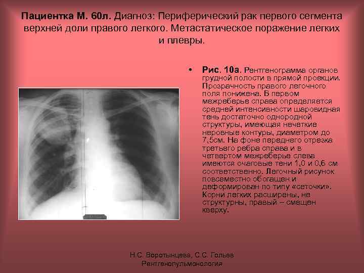 Пациентка М. 60 л. Диагноз: Периферический рак первого сегмента верхней доли правого легкого. Метастатическое