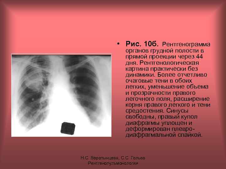  • Рис. 10 б. Рентгенограмма органов грудной полости в прямой проекции через 44