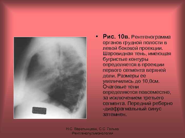  • Рис. 10 в. Рентгенограмма органов грудной полости в левой боковой проекции. Шаровидная