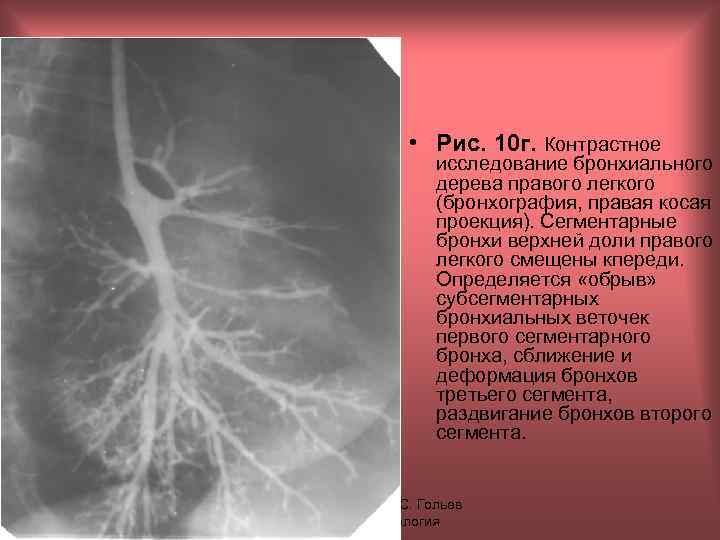  • Рис. 10 г. Контрастное исследование бронхиального дерева правого легкого (бронхография, правая косая