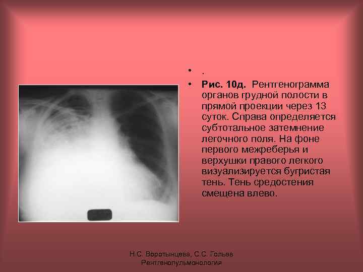  • . • Рис. 10 д. Рентгенограмма органов грудной полости в прямой проекции