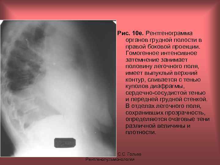Рис. 10 е. Рентгенограмма органов грудной полости в правой боковой проекции. Гомогенное интенсивное затемнение