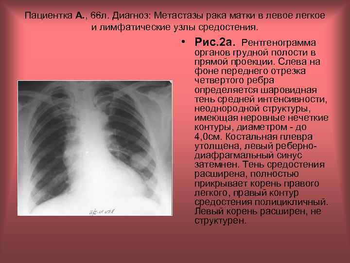 Пациентка А. , 66 л. Диагноз: Метастазы рака матки в левое легкое и лимфатические